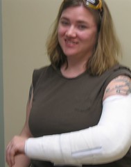 The splint, and a brave face for the nurses