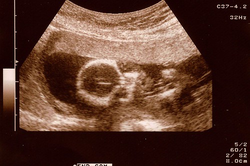 Alien Baby Ultrasound