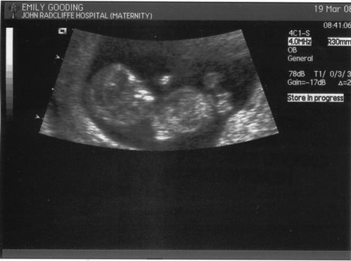 Ultrasound scan of our second child