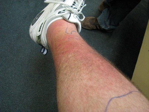 # Dark Spots On Legs Diabetes ★★★ Okra Cure For Diabetes