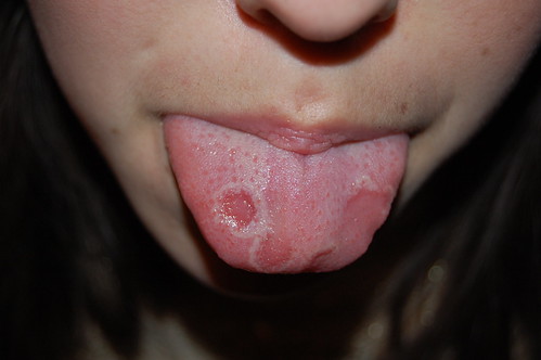 Pictures Of Spots On Tongue 120