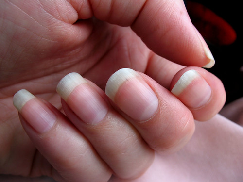 Fingernail Fungus Symptoms Some tips that may help to prevent the occurrence