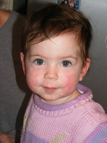 infant heat rash pictures. heat rashes in infants. infant