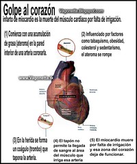 Infarto de Miocardio