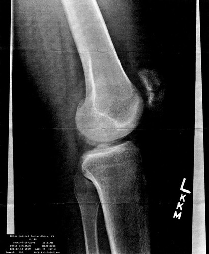 X-Ray of Knee in Profile