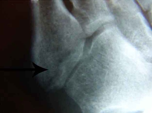 So foot injury: stress fracture of the 5th metatarsal, peroneal tendon tear or tendinitis. MRI next week.