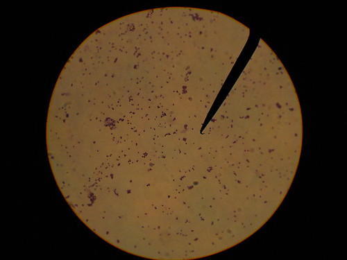 staphylococcus aureus gram stain. Gram stained smear, 100X (oil