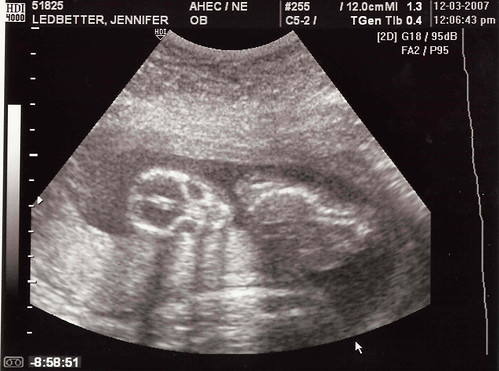 10+weeks+pregnant+ultrasound+pictures