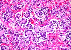 Neuroblastoma of the Adrenal Gland (1)