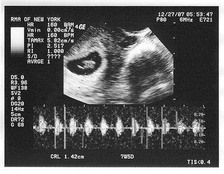 ultrasound 7 weeks 4 days with heartbeat