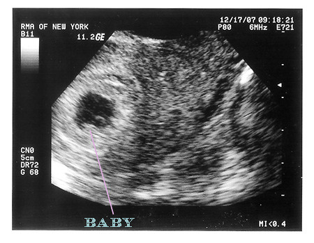 ultrasound at 6 weeks 1 day