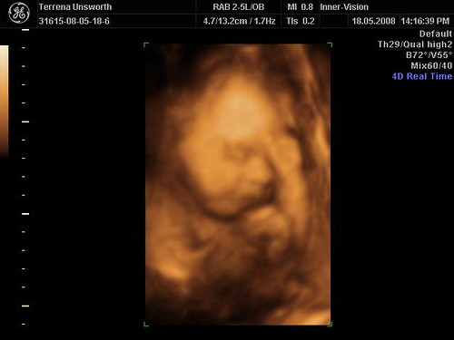 3d ultrasound scan. Baby D + T 3d Scan