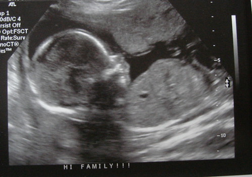 ultrasounds at 6 weeks. 19 weeks ultrasound