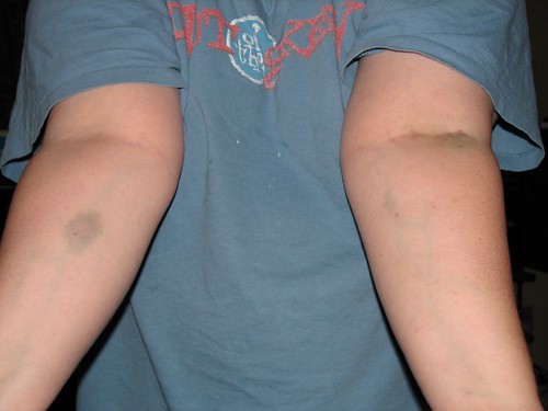 bruises