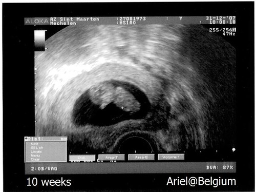 10 weeks Ultrasound