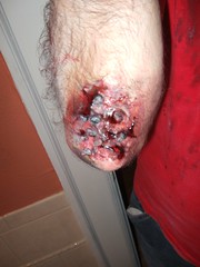 Disgusting elbow wound