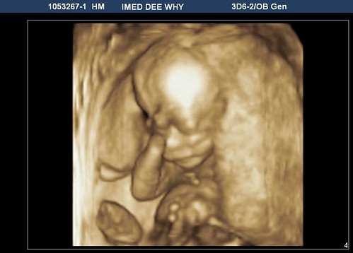 3d ultrasound scan. Alex 3D Ultrasound @ 19 weeks