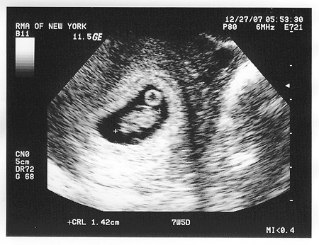 ultrasound 7 weeks 4 days