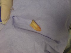 the remains of my tooth