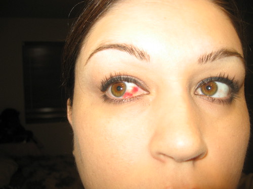 blood vessels burst in eye. Blood Vessel Burst In Eye