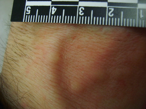 bed bug bites pictures. Close up of where ed bugs had