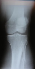 edema in the leg