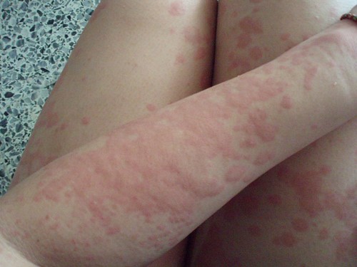 heat rash on baby skin. heat rash pictures in babies.