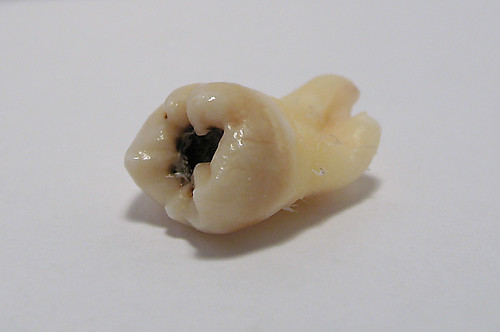 cavities in molars. Maxillary Third Molar
