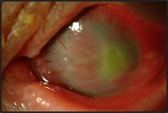 Queratitis severa por hongos, relacionada con el trasplante de córnea