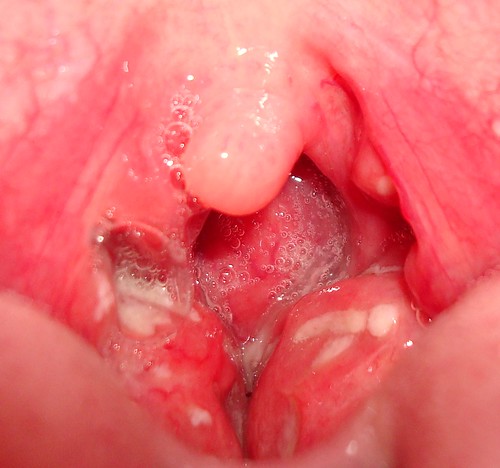 mucus on tonsils
