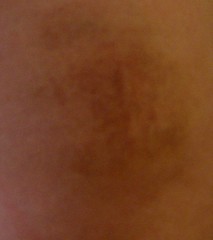 right ass bruise