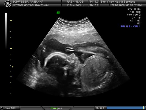 3d Ultrasound Images. 3D Ultrasound