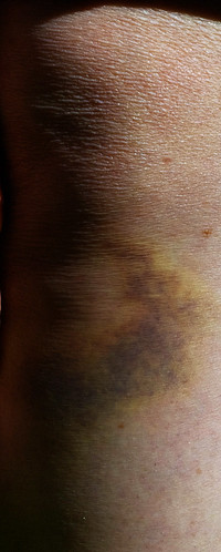 2009-06-19-Bruise01