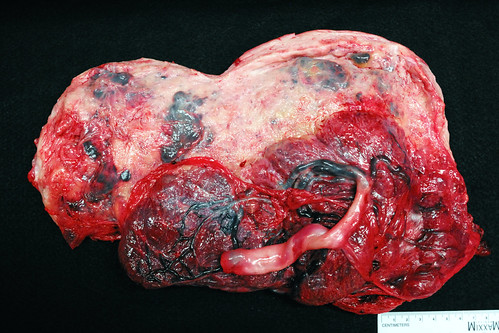 placenta accreta histology