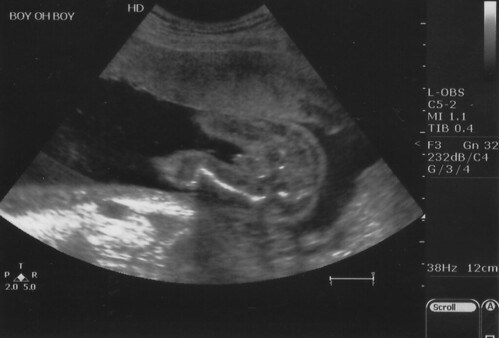 Boys Ultrasound Pictures