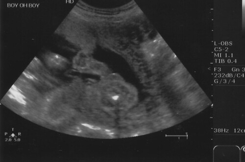 ultrasounds at 6 weeks. Ultrasound 22 weeks-6
