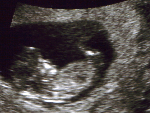 11 weeks pregnant. 11 weeks ultrasound