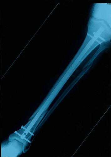 broken leg x ray. My roken leg xray - post op
