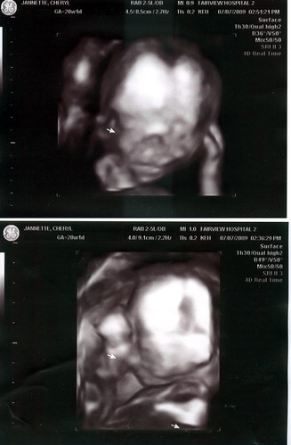 3d ultrasound pictures at 12 weeks. 3D Ultrasound 20 Weeks