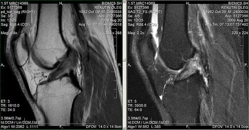 MRI sagittal view of knee, full ACL tear