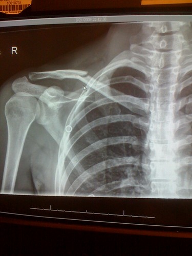 The x-ray just doesn't have 2011