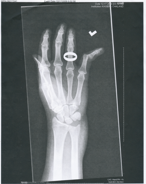 x-ray of my dislocated pinkie