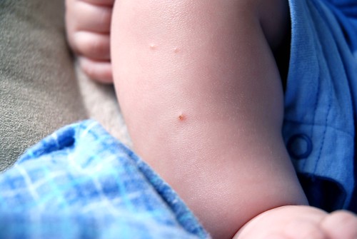 onset of chickenpox. chickenpox!! by mowabby