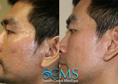  and even deeper lumps (cysts or nodules) that occur on the face, neck, 
