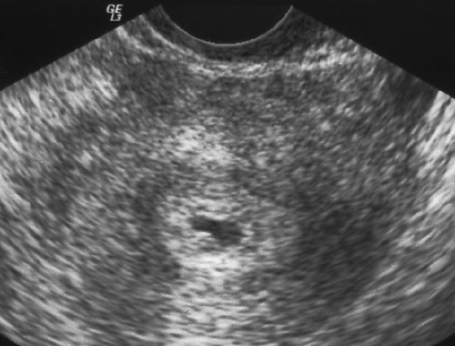 sonogram 5 weeks. Ultrasound at 5 weeks 1 day