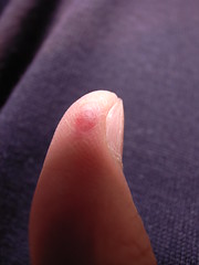Thumb, internal bleeding