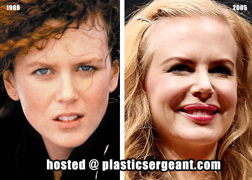 Nicole Kidman Lip Augmentation. From 1989 to 2005.