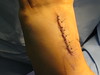 The Stitches