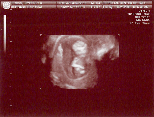 12 5 week ultrasound. 12th Week Ultrasound - 3D