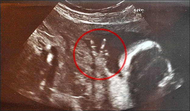 Thumb Bebé hace señal de la paz y amor en ultrasonido del vientre materno